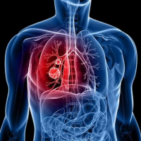 ORMUS ca remediu in cancerul pulmonar